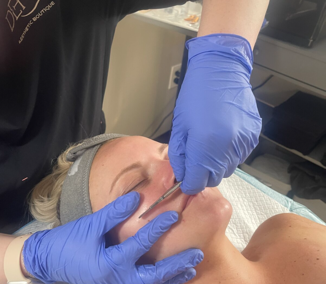 dermaplane facial