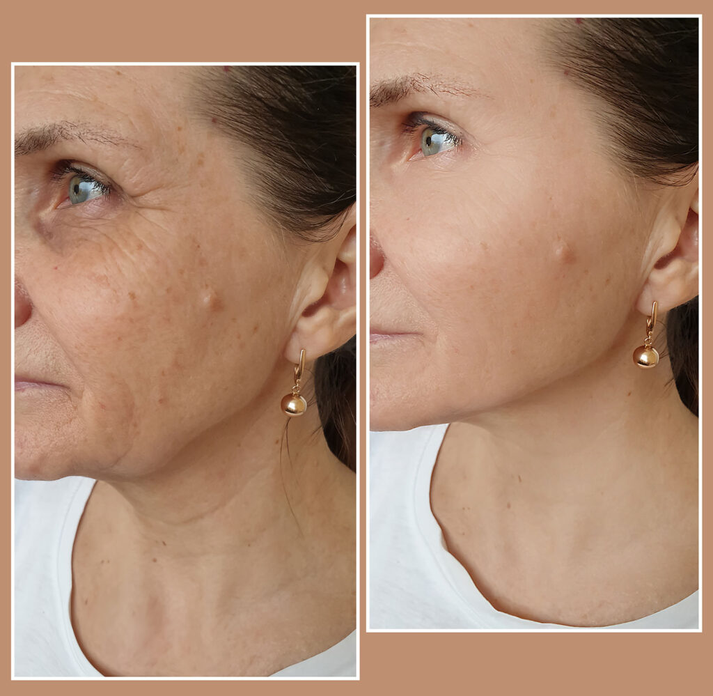 Side-by-side before and after images showing reduced wrinkles and smoother skin after Botox.