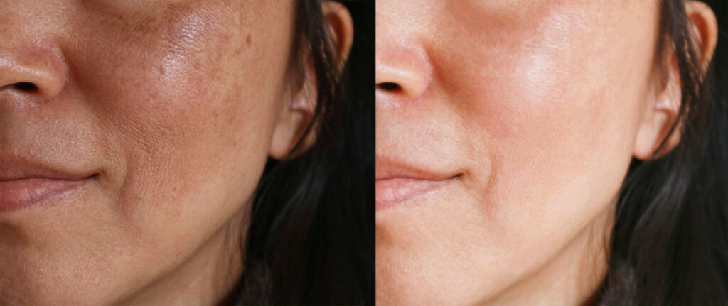 Left and right close-up cheek images showing visible differences in skin texture and coloration.