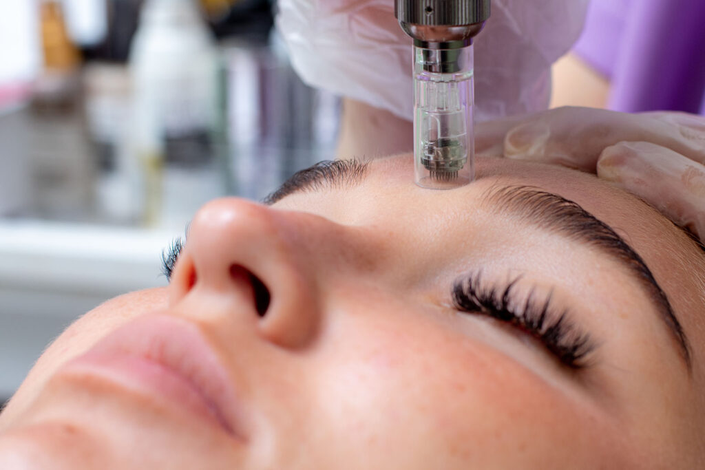 A close-up view of a microneedling device pressed gently onto a woman’s forehead during treatment.
